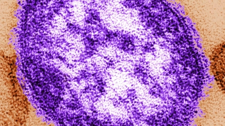 Measles case reported at LAX, Orange County children’s hospital